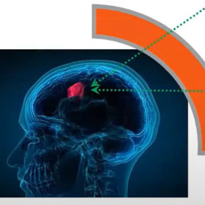 MLL 2 May Brain Cancer