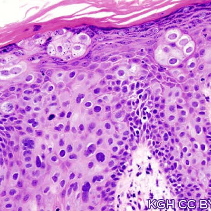 cutaneous squamous cell