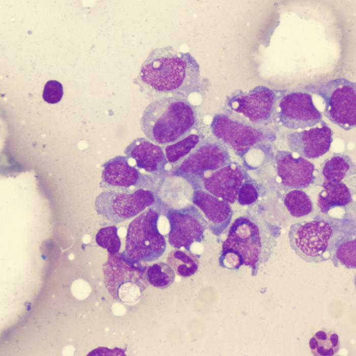 SARCOMA