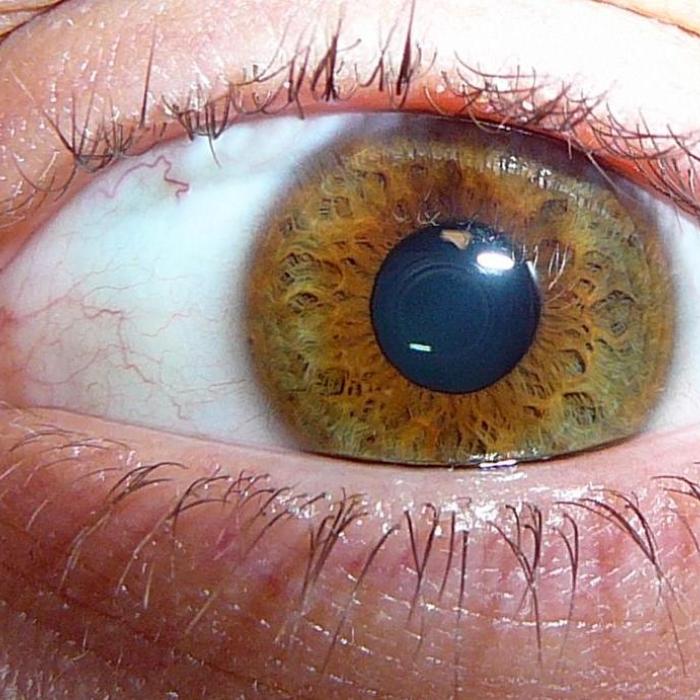  Ocular Melanoma
