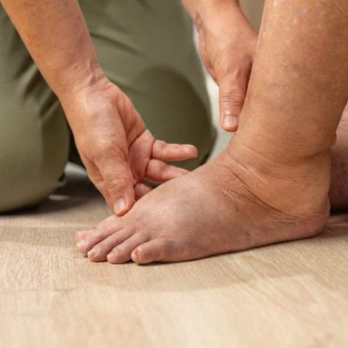 Lymphoedema - canva
